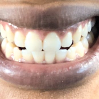 Capitol Perio - After - Periodontists Near Me - Elk Grove, California Capitol Perio - After - Periodontists Near Me - Elk Grove, California