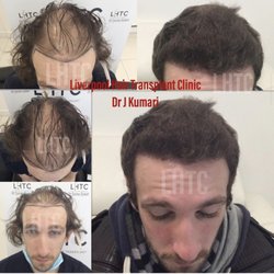 Liverpool Hair Transplant Clinic - 6 Months Results only Hair Transplant by Dr Kumari