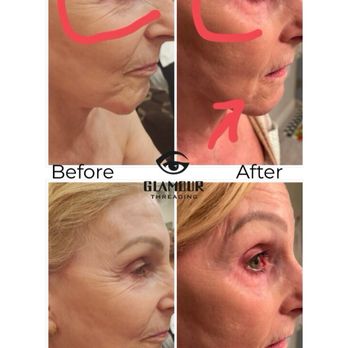 Glamour Threading  - 6layers peel. - Threading Services Near Me - Castro Valley, California