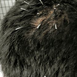 Scalp acupuncture, can help with a variety of issues, including neurological disorders, headaches, and hair loss.