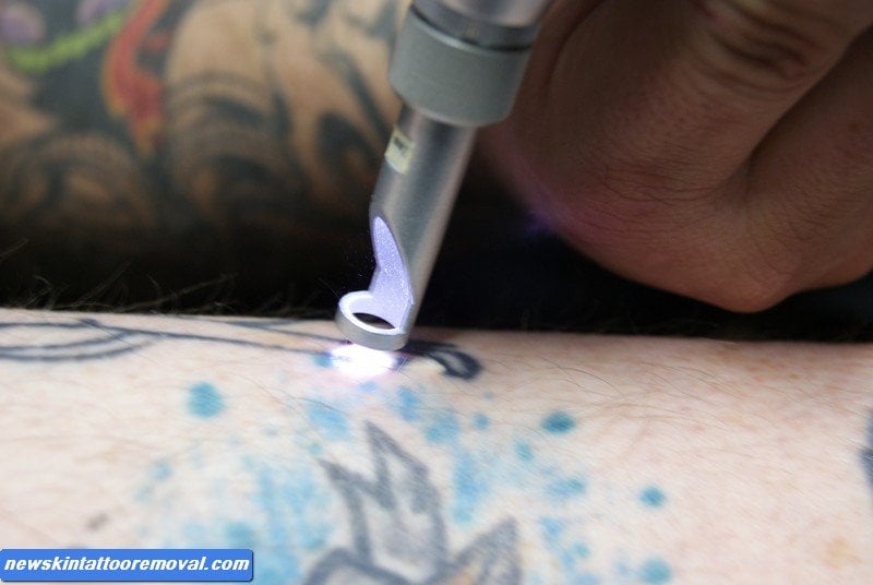 NewSkin Tattoo Removal Logo