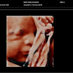 Peek A Boo Baby 3D 4D Ultrasound - 5D Face/Leg