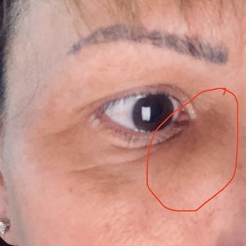 New Image Med Spa - Up close lump of filler migration to under eye - Laser Hair Removal Near Me - Phoenix, Arizona