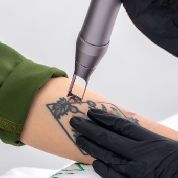 Haven Permanent Cosmetics and Aesthetics - PicoWay Laser Tattoo Removal at Haven. - Cosmetics & Beauty Supply Near Me - Gig Harbor, Washington