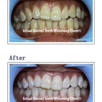 Instant Beauty Spa - Teeth Whitening Near Me - Phoenix, Arizona Instant Beauty Spa - Teeth Whitening Near Me - Phoenix, Arizona