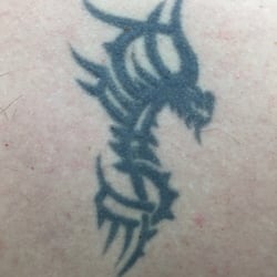 Advanced Laser Clinics - Before
