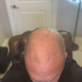 Vantis Institute - BEFORE (February 2020) Vantis Institute procedure - Hair Loss Centers Near Me - Newport Beach, California Vantis Institute - BEFORE (February 2020) Vantis Institute procedure - Hair Loss Centers Near Me - Newport Beach, California