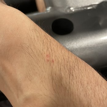 Beverly Laurel Hotel - Bed bug bites on my forearm, provided by my hotel room roommates free of charge - Hotels Near Me - Los Angeles, California
