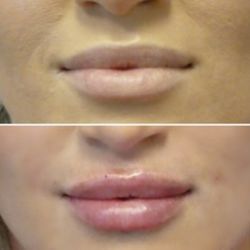 Denver Plastic Surgery and Aesthetics - Denver Plastic Surgery injected 1 syringe of Kysse filler: 1/2 in my lips and the other 1/2 in my nasolabial folds.
