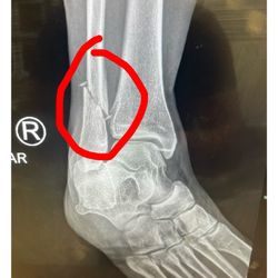 Broken fibula
