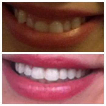 Manchester Dentistry - Before and after 6 month braces. I could not be happier! Dr. Freedman and his staff gave me the smile I always dreamed of. - Cosmetic Dentists Near Me - Manchester, Connecticut Manchester Dentistry - Before and after 6 month braces. I could not be happier! Dr. Freedman and his staff gave me the smile I always dreamed of. - Cosmetic Dentists Near Me - Manchester, Connecticut