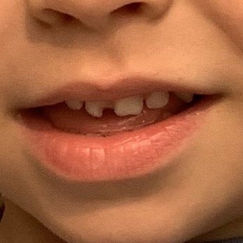 Capital Pediatric Dentistry - Before his procedure - Pediatric Dentists Near Me - Sacramento, California