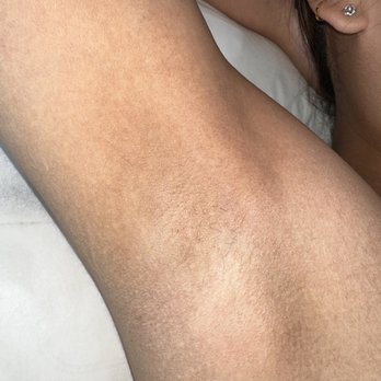 Glam MediSpa - My Underarm with a year of no shaving. - Medical Spas Near Me - Van Nuys, California