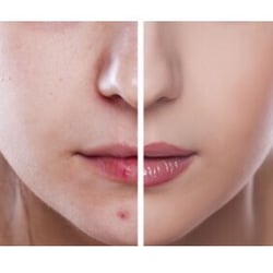GK Dermatology - Jessner chemical peels at GK dermatology