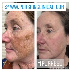 Purskin Clinical - Before and after one PURpeel .