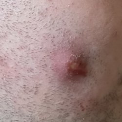 CareNow Urgent Care - Murfreesboro - mrsa NOT bug bite