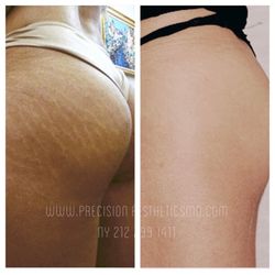 Precision Aesthetics - Get rid of those stretch marks. We have fifty year old women losing 20 year old stretch marks. Do it now ! Imagine how great you will feel