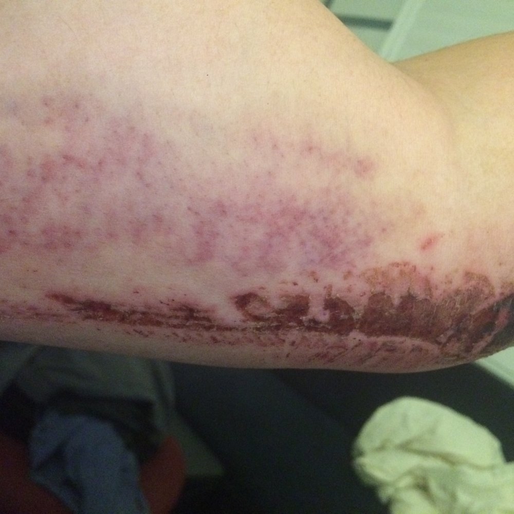 The Accident Guys - injury on my l.arm from the accident - Personal Injury Law Near Me - Corona, California The Accident Guys - injury on my l.arm from the accident - Personal Injury Law Near Me - Corona, California