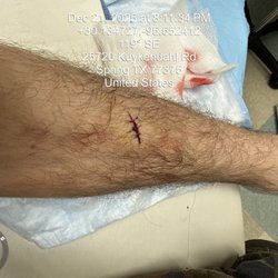 Next Level Urgent Care - Woodlands - My stitches