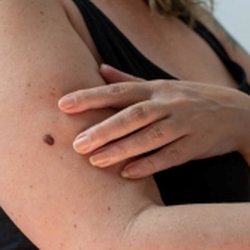 Advanced Dermatology & Skin Cancer Specialists Hemet - Advanced Dermatology & Skin Cancer Specialists - woman showing mole on arm