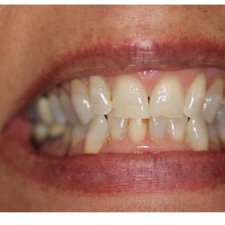Beach Town Braces - Before