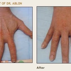 Ablon Skin Institute - Hand Rejuvenation