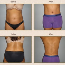 Rocheford Plastic Surgery - Tummy Tuck Before and After