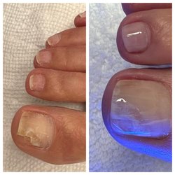 Nails by Luisa Advanced Nail Solution - Toenail reconstruction
