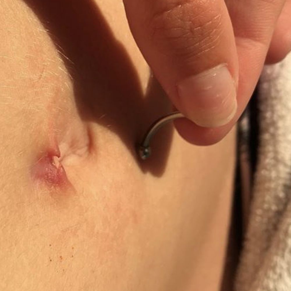 this is the torn skin where my piercing once was with the jewelry i had been pierced with.