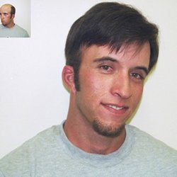 Celebrity Hair - Hair replacement system Before / after