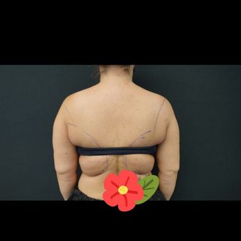 Artistic Lipo & Plastic Surgery - Before - Cosmetic Surgeons Near Me - Tampa, Florida Artistic Lipo & Plastic Surgery - Before - Cosmetic Surgeons Near Me - Tampa, Florida