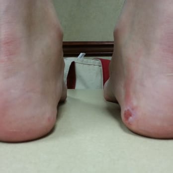 L A Nails - Damage from bad pedicure. - Nail Salons Near Me - Jefferson City, Missouri L A Nails - Damage from bad pedicure. - Nail Salons Near Me - Jefferson City, Missouri