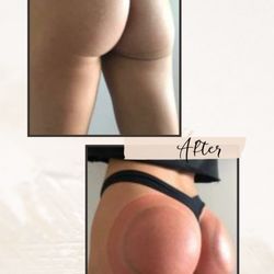 Natures Richness Wellness And Body Sculpting Spa - Tighten and tone your glutes with our non-invasive BBL session