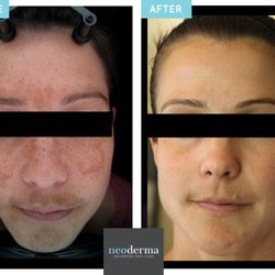We use 3D Skin analysis technology to help track your progress (bacteria levels, wrinkles, etc) while you're undergoing treatment.