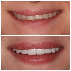 Bright Smile Dental - 10 Porcelain Veneers Before & After