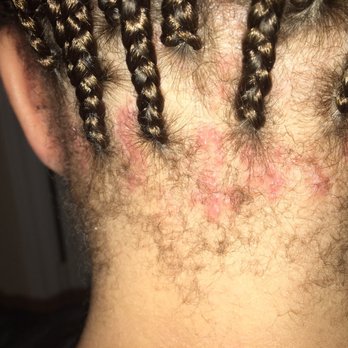 Neat Pretty Braids - Box braids edges redone - redness and bumps from pulling edges too tight - Hair Stylists Near Me - Houston, Texas