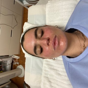 Le Bon Skin Lab - Right after micro needling! My skin was absolutely glowing the next day! - Skin Care Near Me - New York, New York Le Bon Skin Lab - Right after micro needling! My skin was absolutely glowing the next day! - Skin Care Near Me - New York, New York