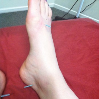 Kimberley Woo, DAOM Dipl.OM EdD - Acupuncture session with Kimberley Woo - Acupuncture Near Me - Carlsbad, California