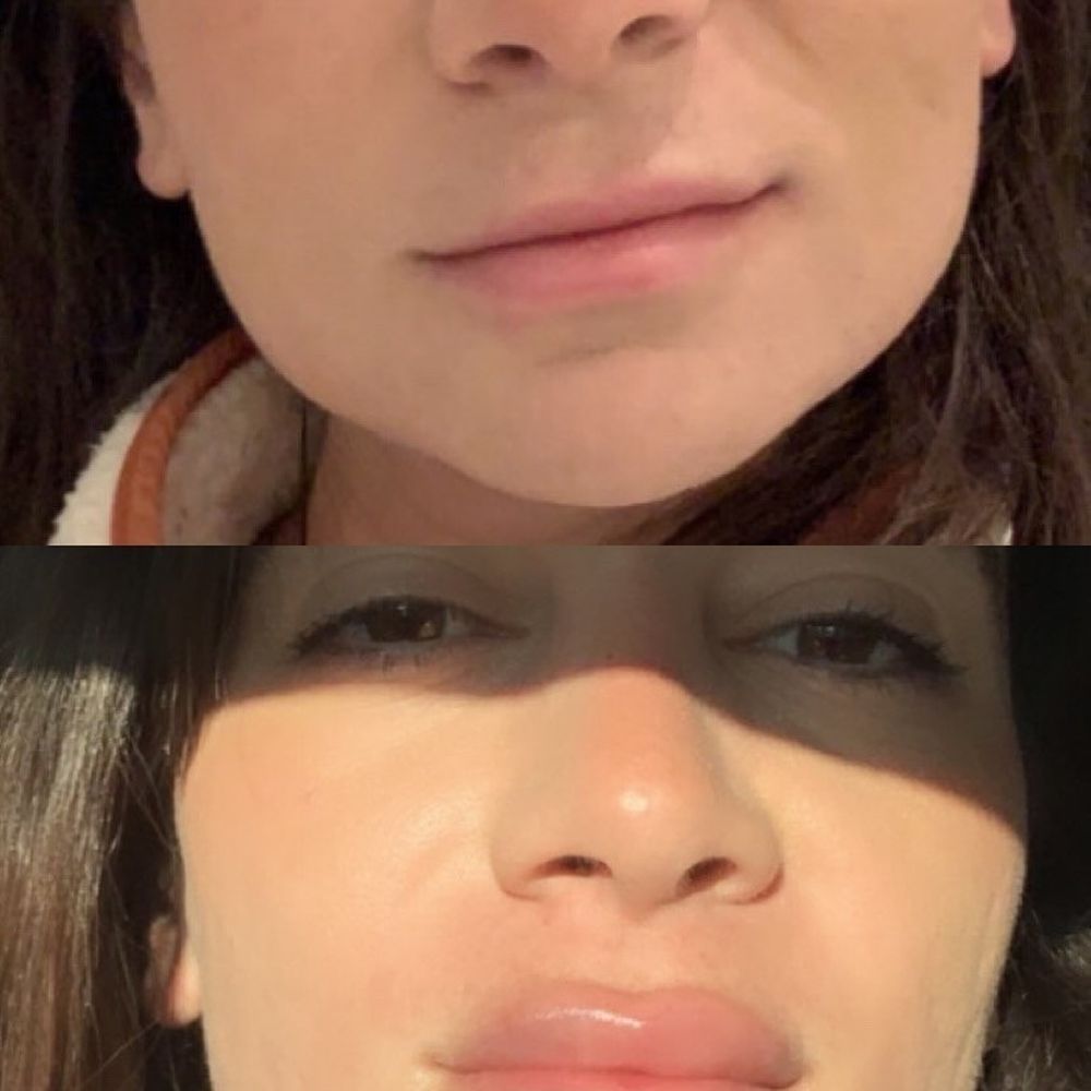 California Cosmetics - Same day filler photo before and after. These photos are taken 1 hour apart. 1 full syringe. - Medical Spas Near Me - Newport Beach, California California Cosmetics - Same day filler photo before and after. These photos are taken 1 hour apart. 1 full syringe. - Medical Spas Near Me - Newport Beach, California