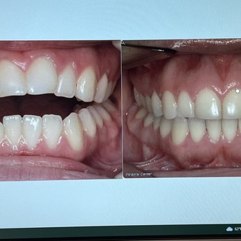 Elite Orthodontics - Left picture is my open Vite in 2013 Right side is post treatment - Orthodontists Near Me - San Diego, California Elite Orthodontics - Left picture is my open Vite in 2013 Right side is post treatment - Orthodontists Near Me - San Diego, California