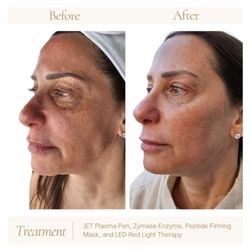 Revive and Renew - Can we please talk about how amazing these results are?!?! The JET Plasma Pen combined with Circadia products and LED light therapy!