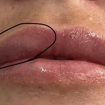 Ideal Image Memphis - MONTHS later they still look like this. Every time I smile, that big ole white bump pops up! Loved my engagement pics with this! - Laser Hair Removal Near Me - Memphis, Tennessee