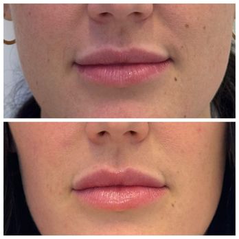 NewSkin - Amazing correction - Medical Spas Near Me - Bellevue, Washington NewSkin - Amazing correction - Medical Spas Near Me - Bellevue, Washington