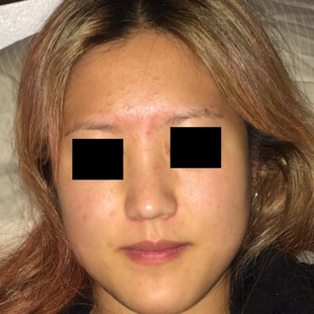 Nancy Satur, MD - 6 month progress - Dermatologists Near Me - San Diego, California Nancy Satur, MD - 6 month progress - Dermatologists Near Me - San Diego, California
