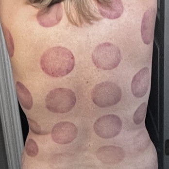 IMR Massage - Eastern - The marks go away in about a week, this was taken the day after. - Massage Near Me - Las Vegas, Nevada