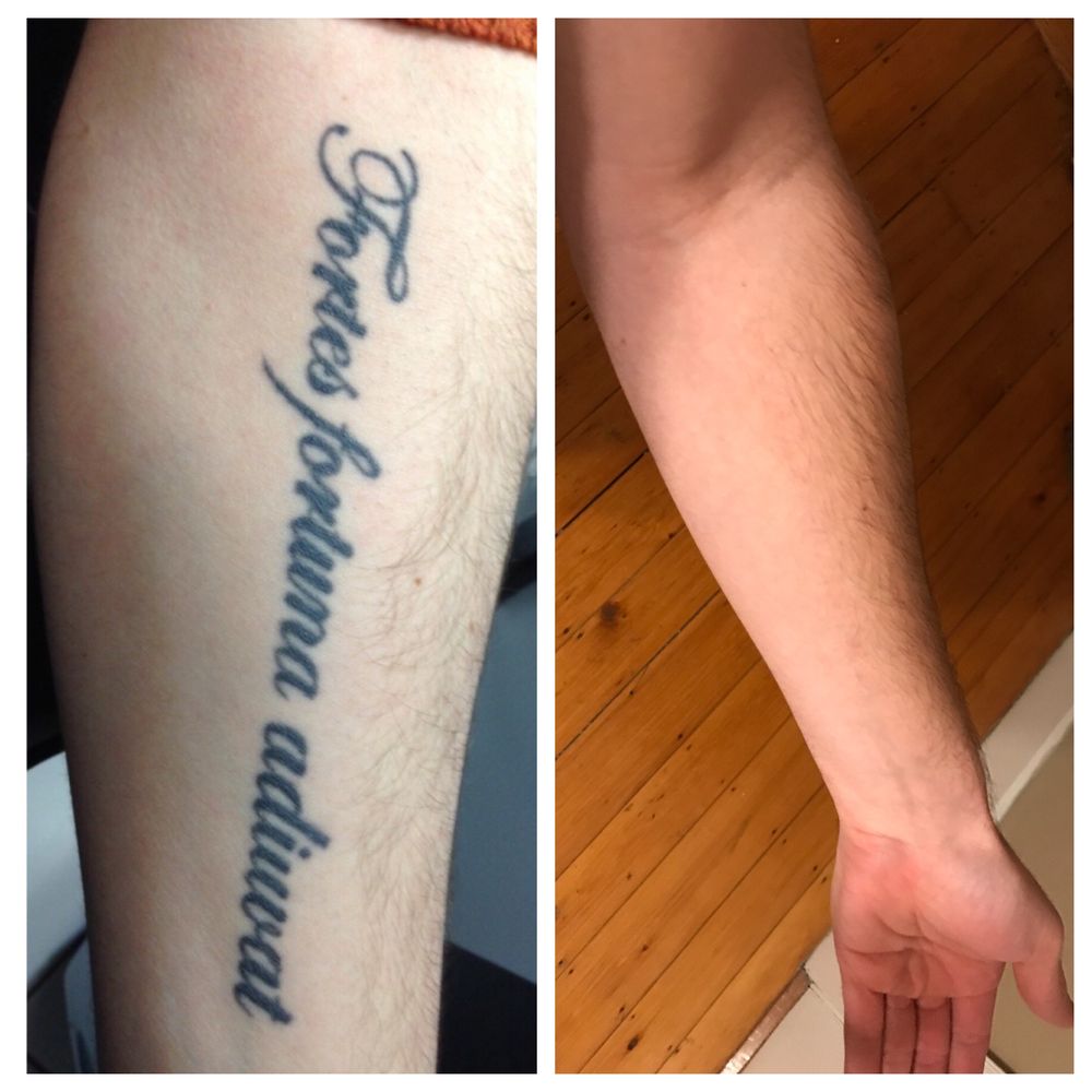 Disappearing inc. - 10 treatments, and my tattoo is gone. Disappearing Inc Framingham. - Tattoo Removal Near Me - Framingham, Massachusetts