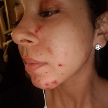 Clinically Clear - Acne Treatment Near Me - San Leandro, California