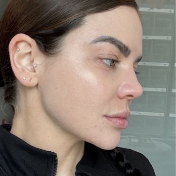 Vitalyc Medspa - After- depreciated skin texture, lack of healthy glow, lack of subcutaneous fat, looks unnatural and not healthy. - Medical Spas Near Me - Dallas, Texas Vitalyc Medspa - After- depreciated skin texture, lack of healthy glow, lack of subcutaneous fat, looks unnatural and not healthy. - Medical Spas Near Me - Dallas, Texas