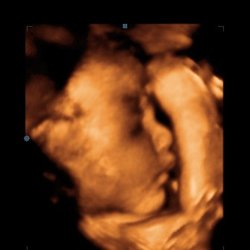 Peekme 3D/4D Ultrasounds
