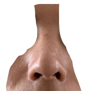 Aesthetic Skin - A year later. Current view of my new nose and nasolabial folds from surgery. It's barely visible but there's a scar between my eyebrows. - Skin Care Near Me - Chicago, Illinois Aesthetic Skin - A year later. Current view of my new nose and nasolabial folds from surgery. It's barely visible but there's a scar between my eyebrows. - Skin Care Near Me - Chicago, Illinois